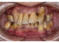 歯磨きしてるのに歯がグラグラするのは、なぜ❓❓